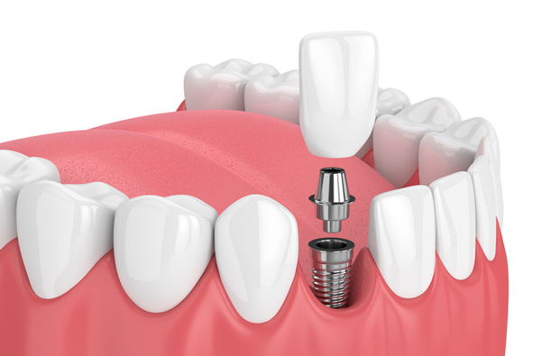 dental implants permanent replacement of missing teeth algeria algiers ain benian