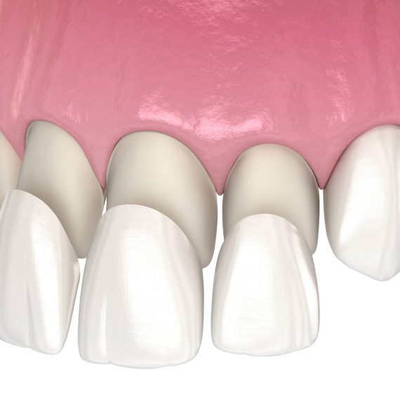 Hollywood smile avec facette dentaire, Ain benian, Alger, Algérie