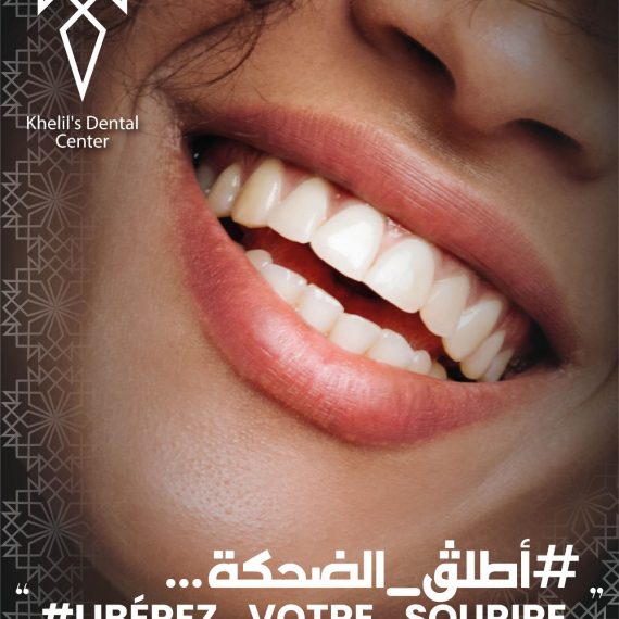 hollywood smile à Alger, en Algérie, Pose effectuée à la clinique dentaire Khelil's dental center à Alger, Photo après hollywood smile
