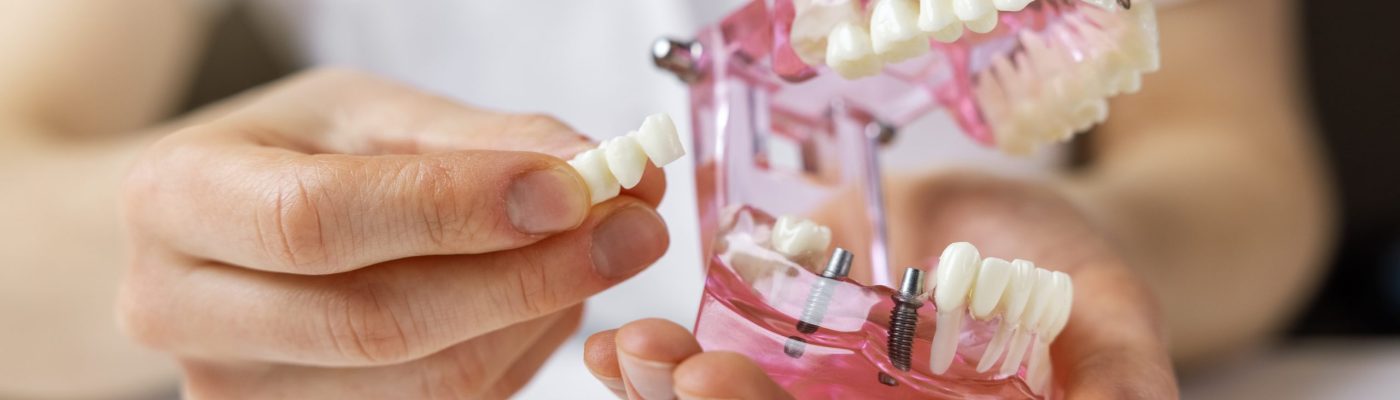 chirurgien dentiste implantologue montrant un bridge sur implants dentaires sur un model humain