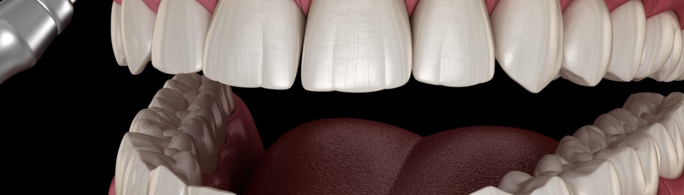 gingivectomie, traitement du sourire gingival en Algérie à Alger